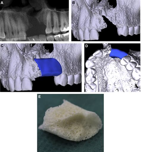 Reconstruction Of A Unilateral Alveolar Cleft Using A Customized