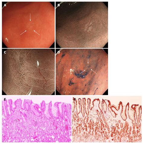 Signet Ring Cell Carcinoma Stomach