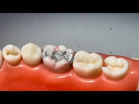 Class II MOD Amalgam Restoration Part2 YouTube