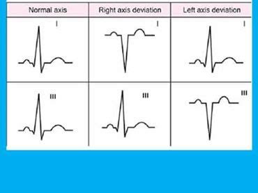 Ekg Axis Deviation Chart