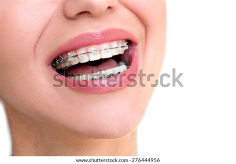 Teeth Braces Closeup Female Open Mouth Stock Photo 276444956 | Shutterstock