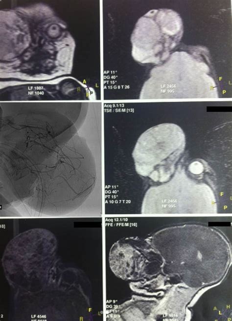 A Newborn With A Giant Teratoma Of The Right Orbit Medizzy Journal