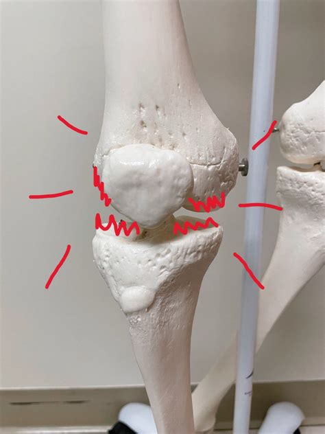 Treatment & Prevention of Knee Arthritis