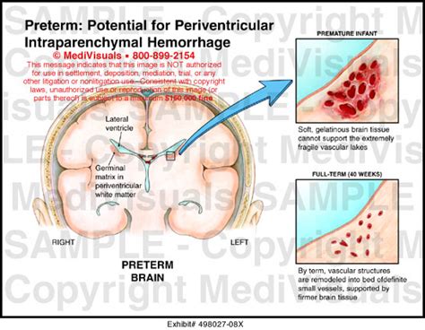 Medivisuals Preterm Potential For Periventricular Intraparenchymal Hemorrhage Medical Illustration