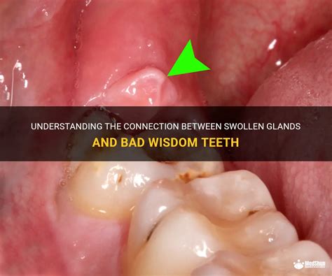 Understanding The Connection Between Swollen Glands And Bad Wisdom Teeth Medshun