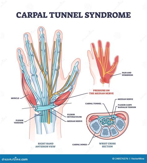 Carpal Tunnel Syndrome With Median Nerve Pressure Disease Outline ...