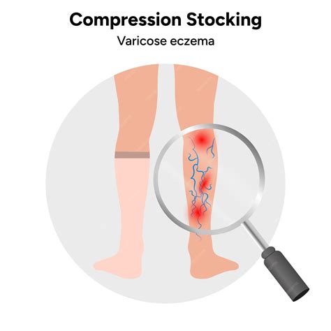 Premium Vector | Compression stocking varicose eczema