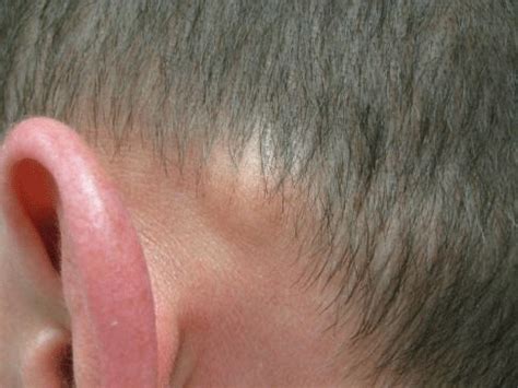 Как лечить липомы с помощью средств народной медицины