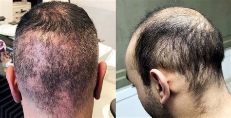 Hair Transplant Cost Hong Kong Dr Bertram