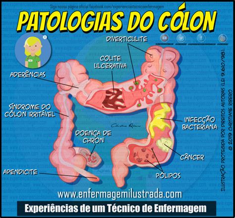 Cólon Sigmoide Inflamado Sintomas - Conheça as Principais Patologias do Cólon | Enfermagem Ilustrada