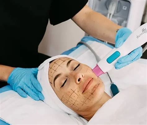 Thermage Skin Tightening The Ultimate Guide