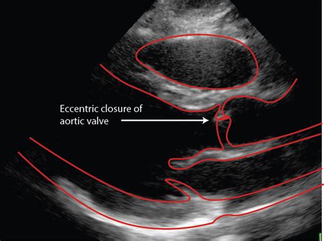 Bicuspid Aortic valve Archives - Critical Care Sonography