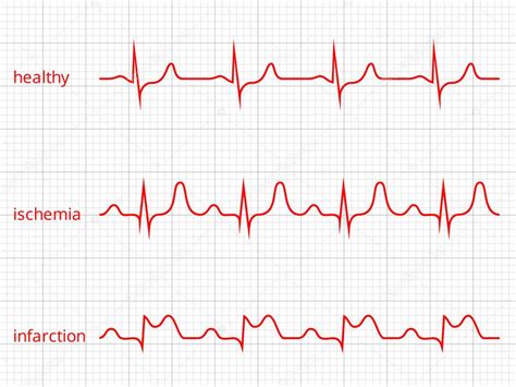 Conjunto De Gráficos De Cardiograma Cardíaco Ritmo Cardíaco Sano Isquemia Infarto 2022