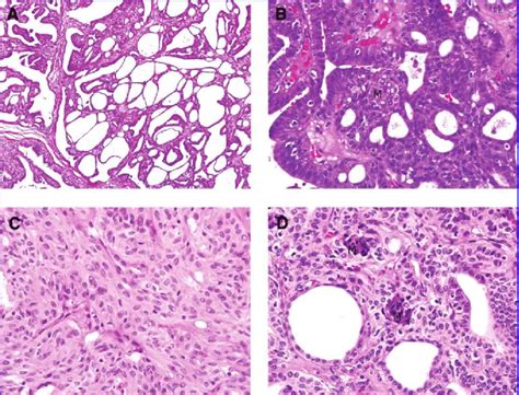 Morphological Features Of The Cribriformmorular Variant Of Papillary