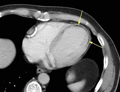 RiT radiology: Subendocardial Fat in Myocardial Infarction