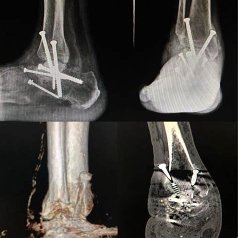 Preoperative X-ray and MRI showing subluxated talonavicular and... | Download Scientific Diagram