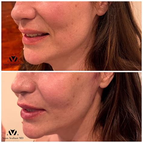 Snatched Jaw Line With PDO Threads By Threads Expert Dr Avaliani Anna