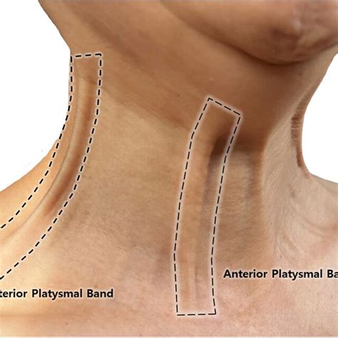 The Thickness Of The Platysma Muscles Front And Back Edges Were Not