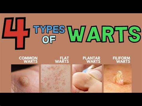 The 4 Main Types Of Warts Youtube