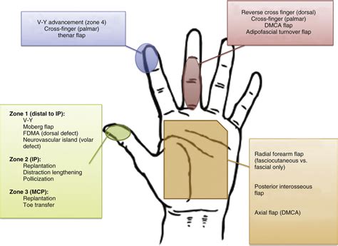 Nail Bed Injuries Soft Tissue Amputations And Replantation Plastic Surgery Key