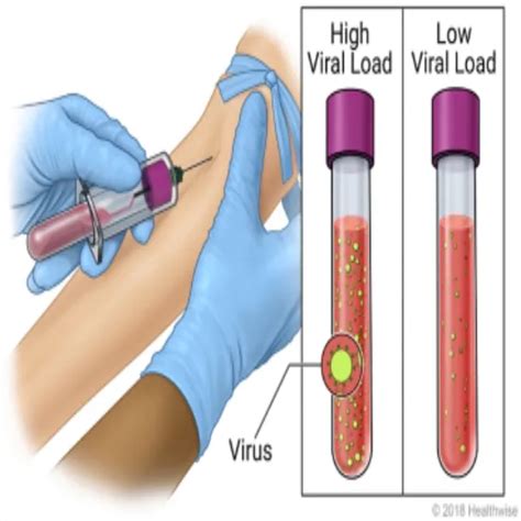 Book Hiv Viral Load Test Price In Delhi Cost Near Me India Ganesh Diagnostic