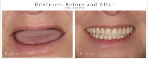 Dentures Before And After Seattle Shor Dental