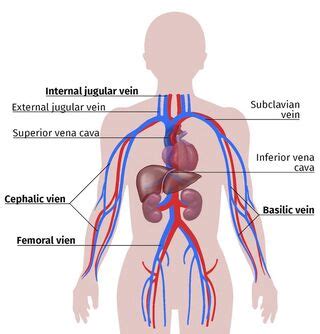 Fistula For Dialysis Placement