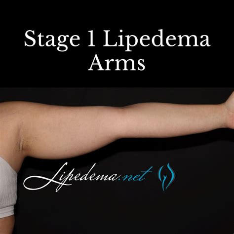 Learn About Stages And Types Of Lipedema