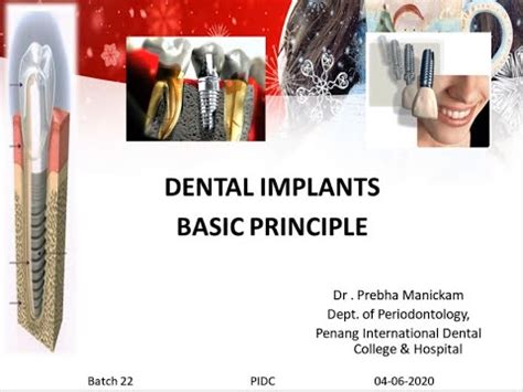 Dental Implants Basic Principle Youtube