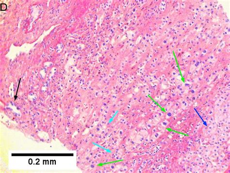 Cholangiocarcinoma Libre Pathology