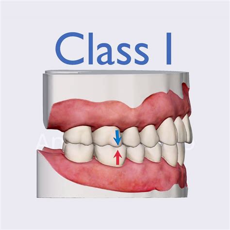 Angles Classification Class I Introduction To Dental Occlusion Dental Anatomy Anatomy