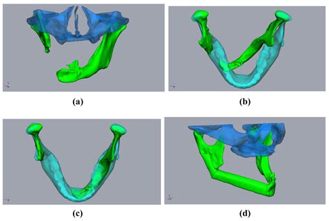 Jpm Free Full Text A Novel Method For Secondary Mandible