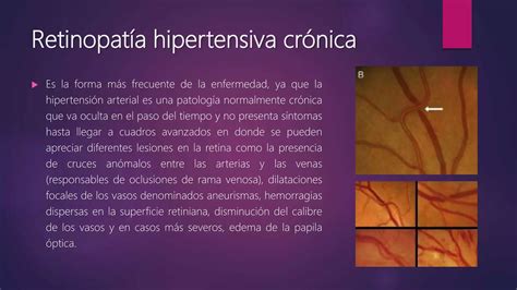 Retinopatía hipertensiva PPT Descarga Gratuita