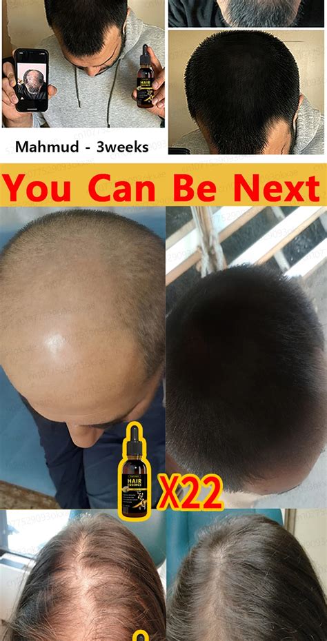 Hair Growth Oil Effective Baldness Repair Hereditary Hair Loss