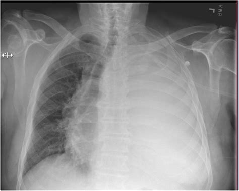 Posterio Anterior Chest Radiograph Shows A Massive Left Sided Pleural