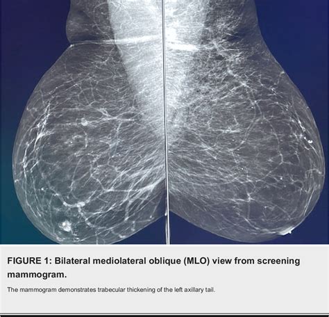 Figure 1 from Mammographic Findings of Diffuse Axillary Tail Trabecular ...