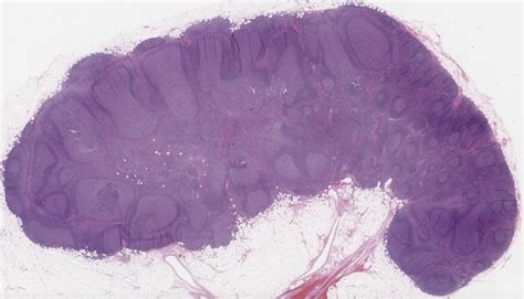 Reactive Lymphadenitis. Lessons From the Friday Unknowns | by Siba El ...