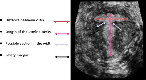 Essential Preoperative Measurements Of T Shaped Uterus Download