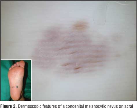 Figure From Dermoscopic Characteristics Of Congenital Melanocytic