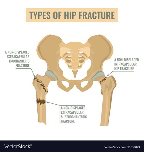 Types of hip fracture Royalty Free Vector Image