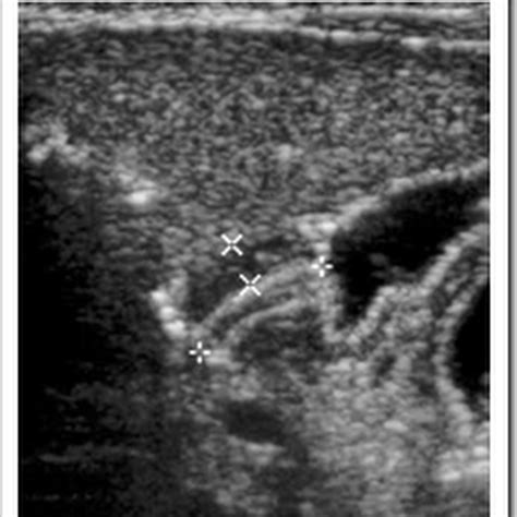 Hypertrophic pyloric stenosis pediatric. - Radiology Imaging