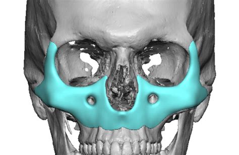 Plastic Surgery Case Study Extended Custom Midface Implant For A