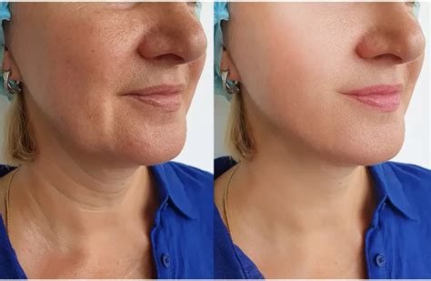 Juvéderm Fillers Before And After Preparation And What To Expect