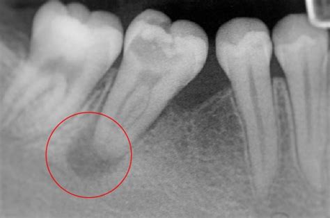 Absceso Dental Qué Es Causas Y Tratamiento Bqdc