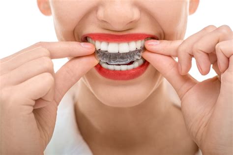 Invisalign Clear Braces