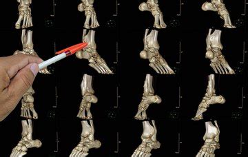 High ankle sprain vs. low ankle sprain: What are the key differences ...