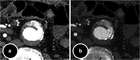 Use Of The Endoleak To Aortic Density Ratio To Distinguish Direct