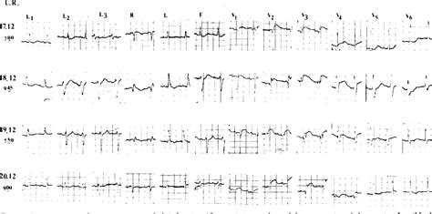 Figure 1 from Left Anterior Hemiblock Obscuring the Diagnosis of Right ...