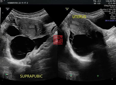 Apa Itu Ovarian Cyst Digeruni Wanita Punca And Simpton