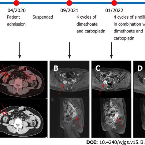 Pelvic Magnetic Resonance Imaging Scans Before And After The Use Of